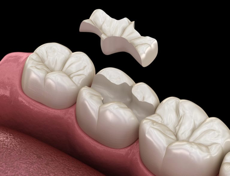 Different Types Of Dental Fillings And Which Is Best For You Bowcutt