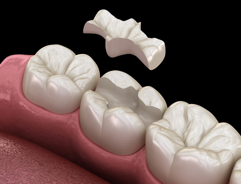 Different Types Of Dental Fillings And Which Is Best For You Bowcutt
